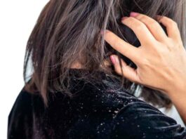8 Remedios caseros que puedes utilizar para eliminar la caspa fácilmente 8 home remedies you can use to remove dandruff easily