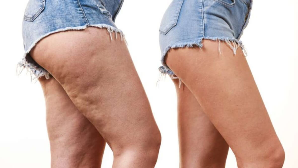 consejos que te ayudaran a reducir la celulitis de tu cuerpo tips that will help you reduce cellulite on your body