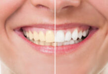 6 Consejos importantes para mantener tus dientes limpios y blancos 6 Important Tips to Keep Your Teeth Clean and White