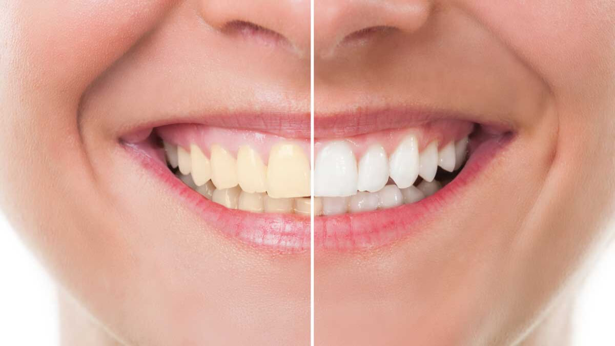 6 Consejos importantes para mantener tus dientes limpios y blancos 6 Consejos importantes para mantener tus dientes limpios y blancos 6 Important Tips to Keep Your Teeth Clean and White