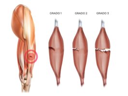 Que es un desgarro muscular y como calmar el dolor de manera natural What is a muscle tear and how to relieve pain naturally
